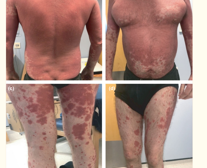 VÍDEO - Covid pode fazer a pele 'entrar em erupção'; Após a vacinação contra a Covid, a pele de algumas pessoas “irrompe” em eczema e outros distúrbios dermatológicos - ENTENDA OS relatórios