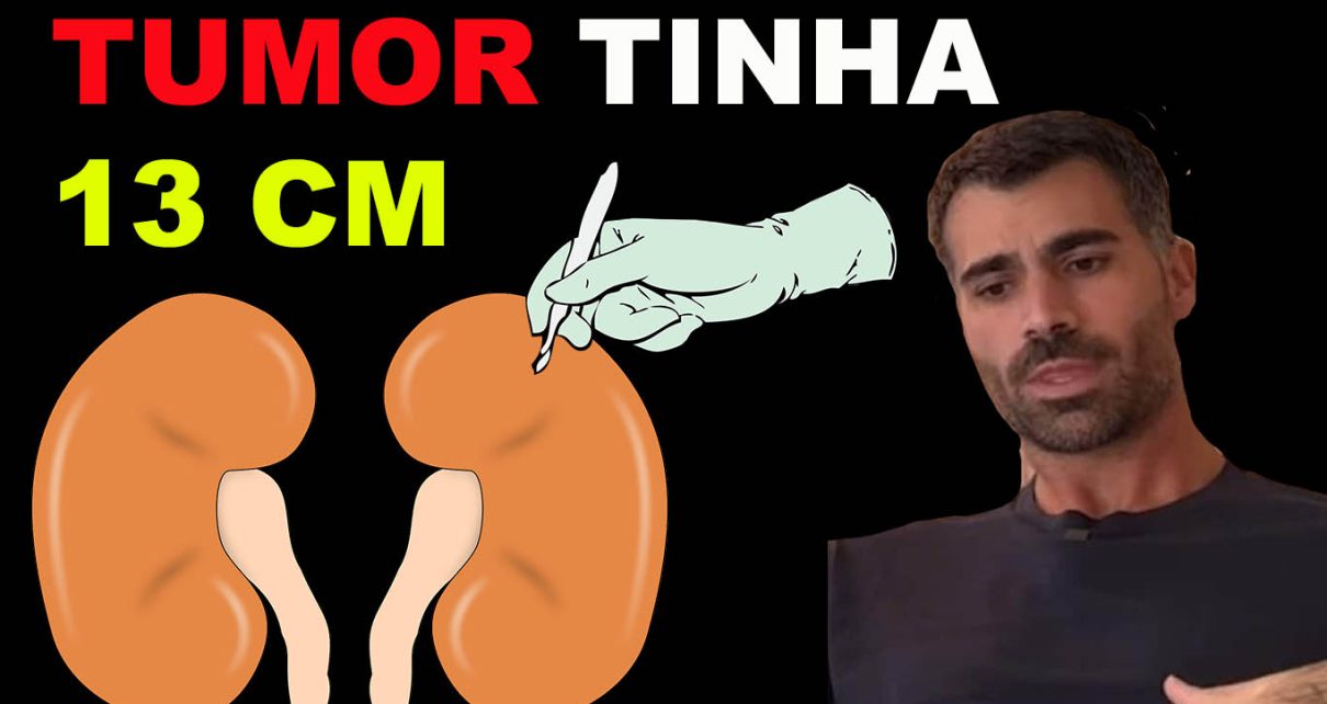 TUMOR - Rodrigão veio à público nesta quinta-feira (19) explicar que, por conta do tumor que enfrentou, precisou remover seu rim esquerdo e o baço. “Tive uma hemorragia e fui internado às pressas, onde foi detectado um tumor de 13 centímetros”, narrou. “O médico falava que era uma bola de handebol. Tinha um tumor de 13 centímetros dentro de mim, estava em volta do meu rim, já estava batendo no meu baço”, explicou ele.
